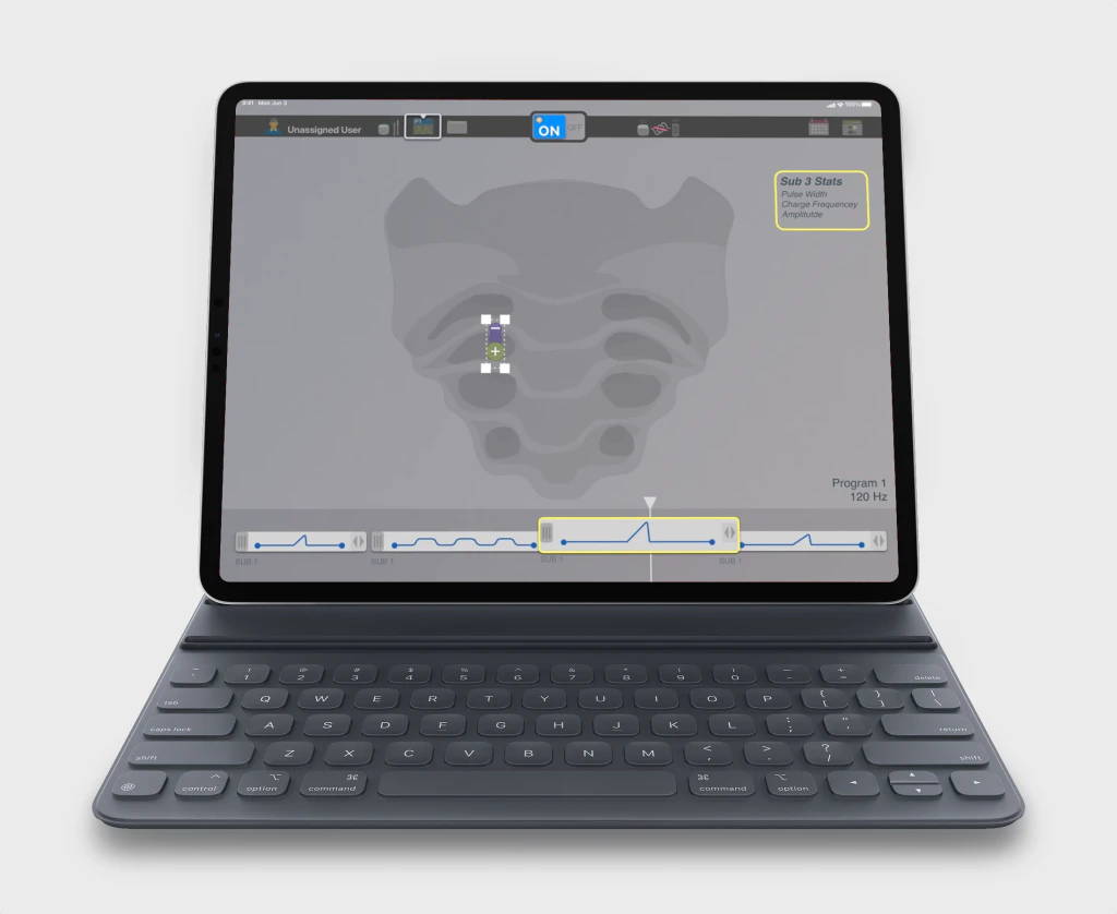 Virtis SNM on a tablet: sacrum lead view above a timeline of therapy programs